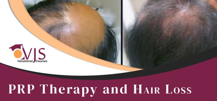 PRP Therapy and hair loss
